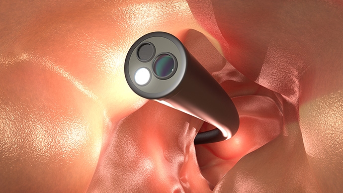 Colonoscopy in Hong Kong: Screening, Government Programmes, and Private Packages